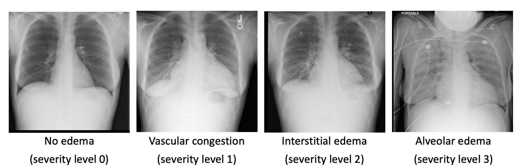 CXR